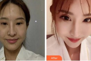 漢中市中心醫(yī)院燒傷整形美容外科李金友整形價(jià)格表附埋線提升案例展示