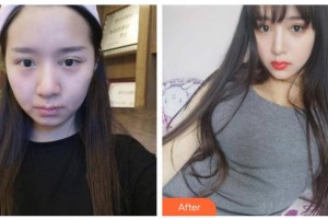 漢中華美醫(yī)療美容診所王巨曠整形價(jià)格表附埋線提升案例展示