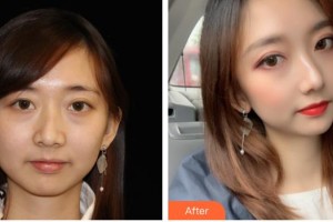 漢中卓美整形外科門(mén)診部李國(guó)棟整形價(jià)格表附熱瑪吉案例展示