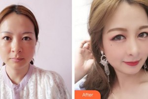 漢中南方醫(yī)療美容診所劉保林整形價(jià)格表附射頻緊膚案例展示