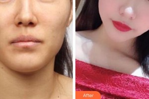 漢中韓美整形美容醫(yī)院李峻福整形價(jià)格表附埋線提升案例展示