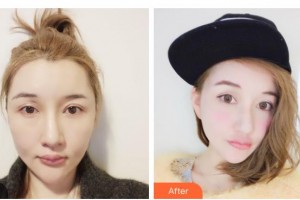 漢中華美奧萊醫(yī)學(xué)整形美容醫(yī)院郭增整形價(jià)格表附超聲提拉案例展示