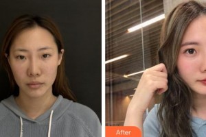 漢中天漢伊美醫(yī)療美容門(mén)診部張茜整形價(jià)格表附熱瑪吉案例展示