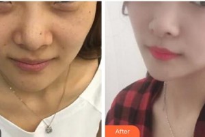 漢中天漢伊美醫(yī)療美容門(mén)診部潘會(huì)章整形價(jià)格表附埋線提升案例展示