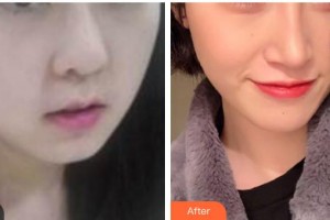 漢中天漢伊美醫(yī)療美容門(mén)診部王伶霄整形價(jià)格表附埋線提升案例展示