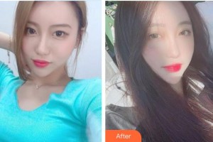 榆林婦產(chǎn)專科醫(yī)院韓式整形美容中心宋寶強(qiáng)整形價(jià)格表附切開雙眼皮案例展示