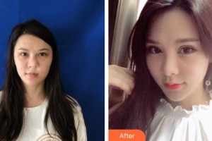 榆林市第一醫(yī)院燒傷整形與皮膚外科席云峰整形價(jià)格表附切開雙眼皮例展示