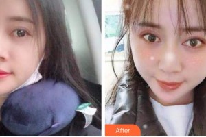 榆林市第四醫(yī)院口腔科張興整形價(jià)格表附自鎖托槽矯正案例展示