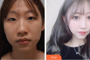 榆林市中醫(yī)醫(yī)院眼科醫(yī)院鄭樹(shù)鋒整形價(jià)格表附定點(diǎn)雙眼皮案例展示