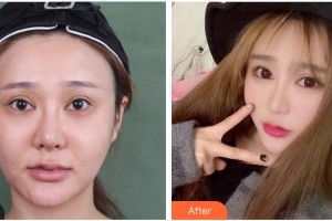 安康希顏醫(yī)療美容診所高景恒整形價(jià)格表附埋線提升案例展示