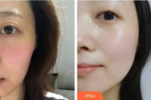 安康蝶姿醫(yī)療美容門(mén)診部慎公關(guān)整形價(jià)格表附美白導(dǎo)入案例展示