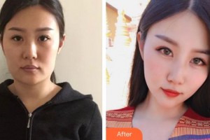 安康希顏醫(yī)療美容診所何云虎整形價(jià)格表附埋線提升案例展示