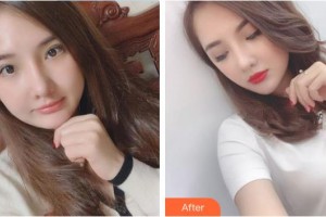 安康永秀醫(yī)療美容醫(yī)院劉祥整形價(jià)格表附埋線提升案例展示