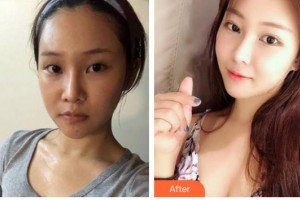 安康市人民醫(yī)院整形外科周櫻整形價(jià)格表附眼部綜合案例展示