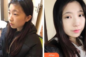 安康愛(ài)爾眼科醫(yī)院方學(xué)軍整形價(jià)格表附開(kāi)內(nèi)眼角案例展示