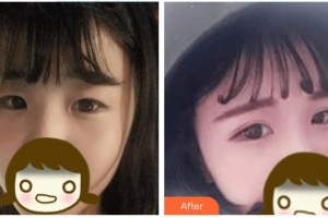 安康愛(ài)爾眼科醫(yī)院周進(jìn)整形價(jià)格表附切開(kāi)雙眼皮案例展示