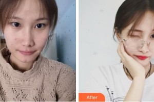 安康愛(ài)爾眼科醫(yī)院李紹偉整形價(jià)格表附眼部綜合案例展示