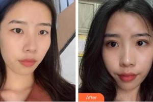 安康希顏醫(yī)療美容診所楊志榮整形價(jià)格表附埋線雙眼皮案例展示