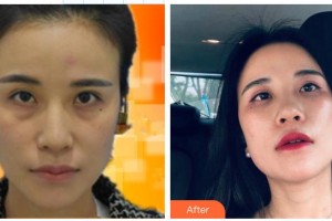 安康愛爾眼科醫(yī)院譚中信整形價(jià)格表附激光去眼袋案例展示