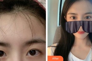 安康愛爾眼科醫(yī)院曾忠玲整形價(jià)格表附眼部綜合案例展示