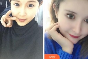 慶陽美立方醫(yī)學(xué)美容診所李梅整形價格表附眼部綜合案例展示