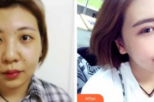 慶陽市人民醫(yī)院醫(yī)療美容科張鑫整形價格表附切開雙眼皮案例展示