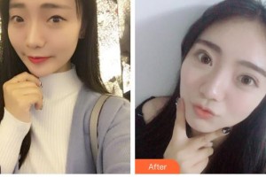 隴南市中醫(yī)醫(yī)院眼科胡月皎住院醫(yī)師整形價格表附切開雙眼皮案例展示