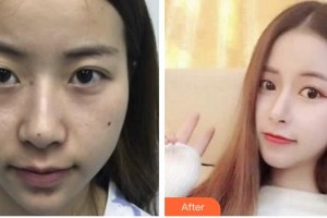 嘉峪關(guān)市紅十字長城醫(yī)院整形美容科靳長安整形價格表附埋線雙眼皮案例展示