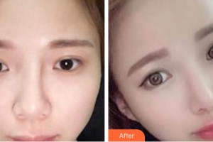 天水退休專家醫(yī)院醫(yī)療美容科焦志云整形價(jià)格表附鼻部綜合案例展示