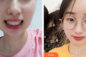 天水市中西醫(yī)結(jié)合醫(yī)院口腔頜面外科宋元元整形價(jià)格表附牙齒隱形矯正案例展示