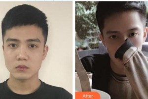 天水韓美整形美容門診部汪喜東整形價(jià)格表附埋線提升案例展示