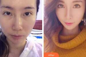 天水韓美整形美容門診部閆相友整形價(jià)格表附埋線提升案例展示