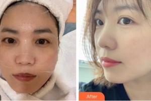 天水韓美整形美容門診部王警豫整形價(jià)格表附激光美膚激光案例展示