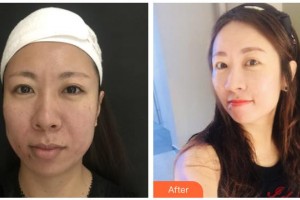 銀川慧頂醫(yī)學美容診所唐玉琴整形價格表附埋線提升案例展示