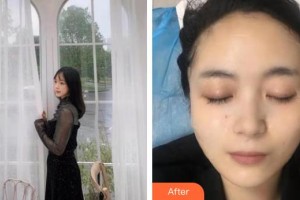 銀川慧頂醫(yī)學美容診所李鴻強整形價格表附黃金微針案例展示