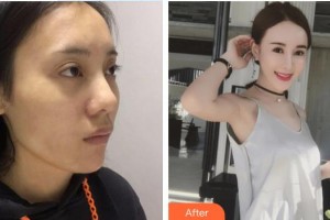 銀川愛美麗醫(yī)療美容門診部邢懷華整形價格表附埋線提升案例展示