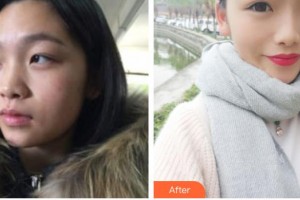 銀川鵬愛悅己醫(yī)療美容門診部劉丹萍整形價格表附埋線提升案例展示