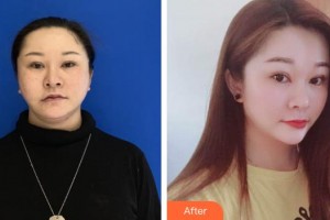 銀川愛美麗醫(yī)療美容門診部金敏慧整形價格表附埋線提升案例展示