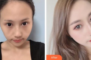 銀川維多利亞醫(yī)療美容醫(yī)院吳濤整形價(jià)格表附埋線提升案例展示