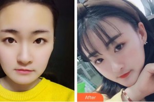 銀川維多利亞醫(yī)療美容醫(yī)院佟新玲整形價(jià)格表附埋線提升案例展示