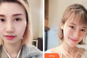 銀川維多利亞醫(yī)療美容醫(yī)院張志國整形價(jià)格表附埋線提升案例展示