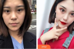 石嘴山市第二人民醫(yī)院燒傷整容中心姜娟整形價(jià)格表附清潔祛痘案例展示