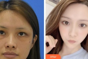 義烏視光眼科醫(yī)院周履真整形價(jià)格表附眼部綜合案例展示