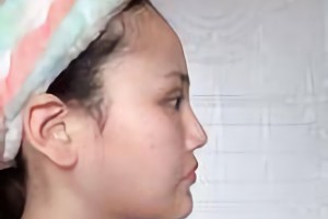 沈陽杏林美容整形醫(yī)院朱石江顴骨顴弓手術(shù)果咋樣？附果圖