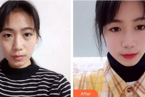 商洛中醫(yī)醫(yī)院燒傷整形科李懷善整形價(jià)格表附切開雙眼皮案例展示