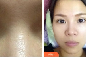 滕州美萊純韓整形醫(yī)院朱丹整形價格表附切開雙眼皮案例展示