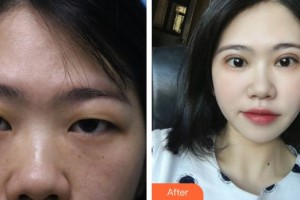 滕州美界醫(yī)療整形診所蘭福良整形價格表附眼部綜合案例展示