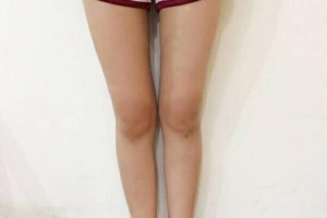 昆明醫(yī)學院整形美容中心如何？附吸脂瘦腿附果圖及價格一覽