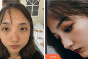 郴州維納斯醫(yī)療美容醫(yī)院劉文閣整形價格表附硅膠隆鼻案例展示