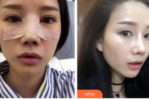 郴州市第四人民醫(yī)院王暉整形價格表附鼻部綜合案例展示